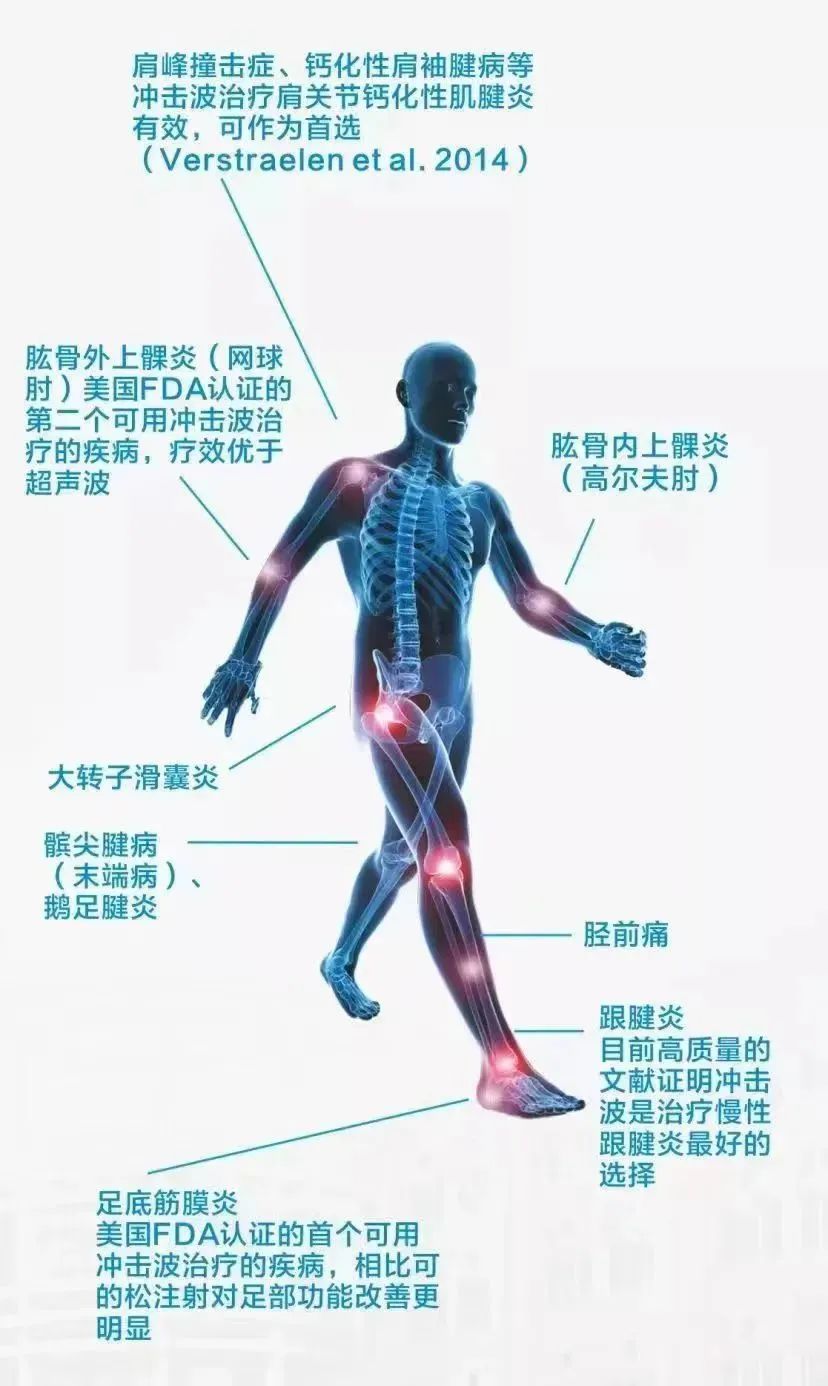 冲击波治疗效果怎么样【新技术 新项目】慢性肌肉疼痛患者的福音_https://www.jmylbn.com_新闻资讯_第6张