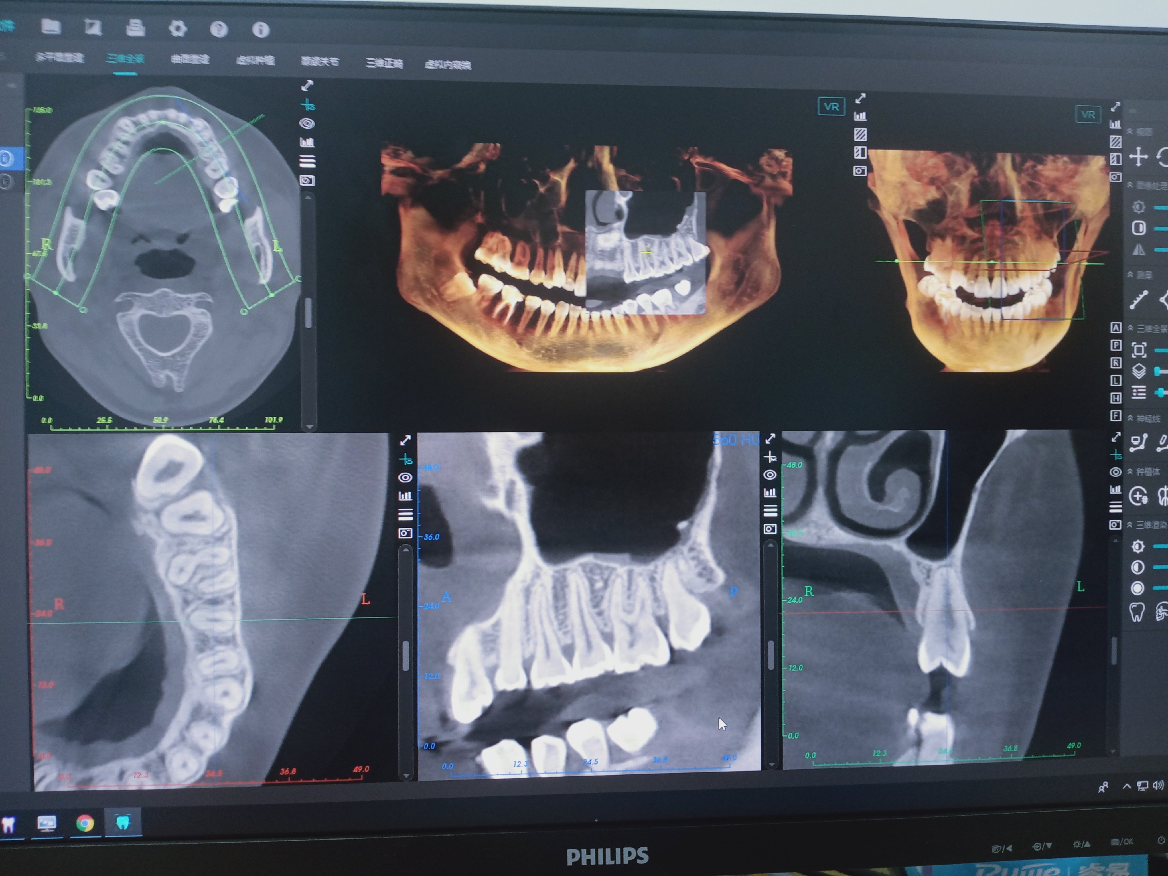 口腔ct怎么看我院口腔科引进CBCT，为目前防城港市检查视野最大的口腔CT检查设备_https://www.jmylbn.com_新闻资讯_第4张